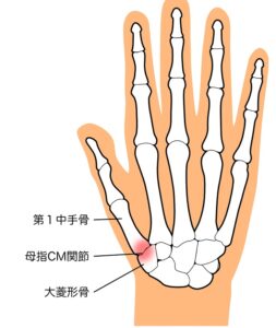 CM関節炎の骨格