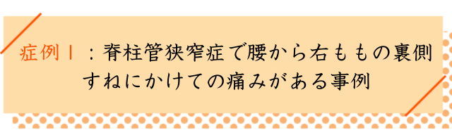 脊柱管狭窄症で腰から右ももの裏側
すねにかけての痛みがある事例